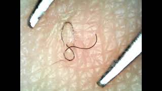 Oddly satisfying Ingrown hair removal [upl. by Htial]