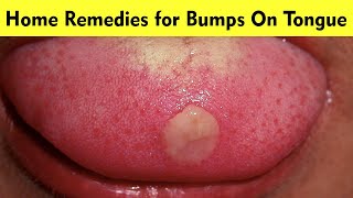 How to Get Rid of Bumps On Tongue That Hurt  12 Home Remedies for Bumps On Tongue [upl. by Audri]