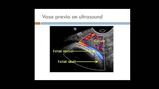 Placental abnormalities  Placenta Previa Vasa Previa Placenta Accreta  Placental Abruption [upl. by Ahsyen505]