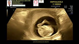 Omphalocele 11 weeks [upl. by Monti]