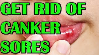 How To Get Rid of Canker Sores And Mouth Ulcers Fast [upl. by Ashelman]