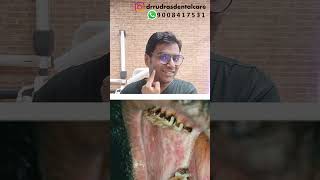 Dr Rudra Mohan Oral Sub Mucous FibrosisOSMFdrrudrasdentalcare drrudramohan osmf osmftreatment [upl. by Xuerd943]