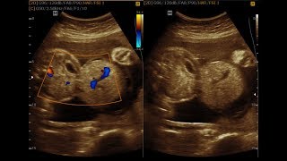 Omphalocele and Bilobed Placenta [upl. by Sykes]