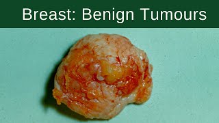 Breast Benign Tumours  Pathology mini tutorial [upl. by Noryb74]