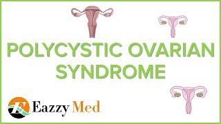 POLYCYSTIC OVARIAN SYNDROME causes pathophysiologysigns and symptoms and treatment [upl. by Zora]