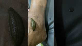 Leech Treatment at Ayurawa Healthcare ayurveda healnaturally [upl. by Bate]