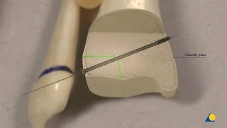 Tibia Distal—Triplane Fracture—Fracture Fixation [upl. by Aremmat]