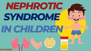 Nephrotic Syndrome In ChildrenCausesSigns And SymptomsDiagnosisTreatmentPaediatrics [upl. by Haropizt170]