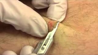 Shave Biopsy [upl. by Olympias]