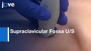 Supraclavicular Fossa US Central Venous Catheter Adjustments  Protocol Preview [upl. by Doggett905]