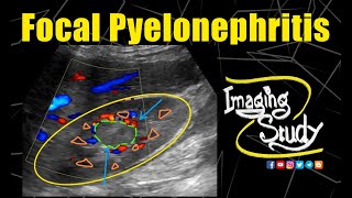 Focal Pyelonephritis in Pregnancy  Ultrasound  CT  Case 192 [upl. by Eliason]