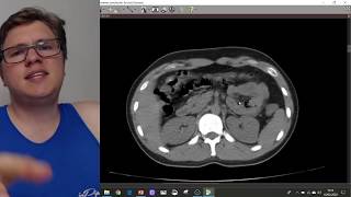 COMO AVALIAR UMA TC DE ABDOME   Anatomia e o que olhar primeiro I VOCÊ RADIOLOGISTA [upl. by Aletha]