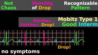 ECG Tutorial AV block EKG Mobitz electrocardiogram interpretation [upl. by Supen]