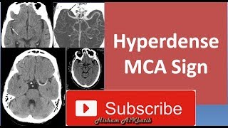 Hyperdense MCA Sign [upl. by Ernestus]