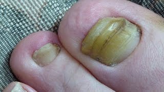 Toenail Fungus Cured 2 Years Progress [upl. by Leasim]