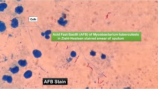 AFB Positive Slide of Mycobacterium tuberculosis [upl. by Emse]