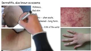 Dermatitis vs Eczema are they same Types of dermatitis symptoms prognosis and treatment [upl. by Lonne]