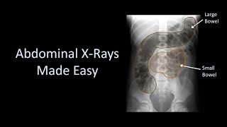 Abdominal XRays Made Easy [upl. by Fairlie]