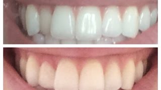 Fixing a crooked tooth inexpensively  quotDental Composite Overlayquot [upl. by Maibach]