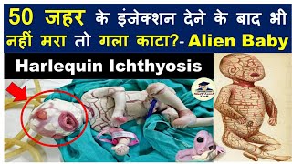 Harlequin Ichthyosis A severe genetic disorder that affects the skin  Alien Baby upsc ias cse [upl. by Saville]