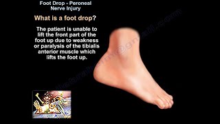 Foot Drop Peroneal Nerve Injury  Everything You Need To Know  Dr Nabil Ebraheim [upl. by Gardel]