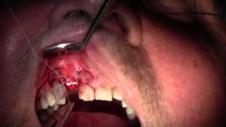 Extraction 7 amp Repair of Dehiscence Defect Suturing Technique [upl. by Nanni]