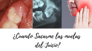 🤕 Tienes que VER este VIDEO antes de SACARTE las MUELAS del JUICIO 🤕 [upl. by Nolyaw363]