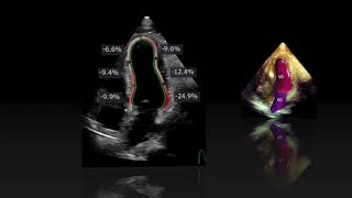 Ischemic Cardiomyopathy Apical dyskinesia [upl. by Asiilanna]