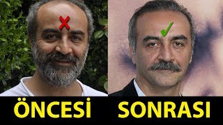 Saç Ektiren ve Protez Saç Kullanan Ünlüler Öncesi  Sonrası [upl. by Manaker56]