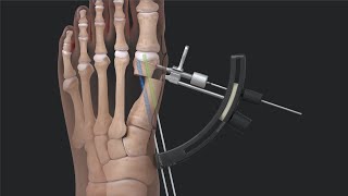 Arthrex Minimally Invasive Bunionectomy System Surgical Technique [upl. by Egbert580]