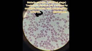 Malariapathology schizont  Plasmodium vivax medical Hematology [upl. by Ytsim205]