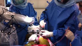 Total Hip Replacement Using MAKO Robotic Assistance [upl. by Cohlette857]