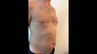 Vaser liposuction HiDef Six Pack Before amp After Ozge Ergun MD  Plastic Surgery  Istanbul [upl. by Stanislaw648]