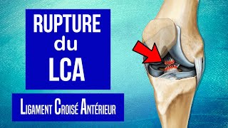 Rupture du Ligament Croisé Antérieur du genou LCA  Les traitements [upl. by Peder]