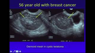 Ultrasound of Adnexal Masses [upl. by Idham]