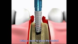 Dental implant procedure [upl. by Nymrak619]