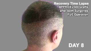 Hair Transplant Review 2013 19 DAY RECOVERY TIME LAPSE OF DONOR AREA POST OP [upl. by Stevy914]