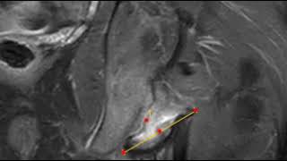 Fracture of ischial apophysis [upl. by Colyer]