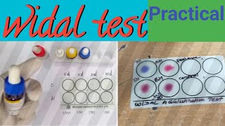 Widal Test Practical  Qualitative Widal Test  Quantitative Widal Test  Typhoid Test  widaltest [upl. by Atinit81]