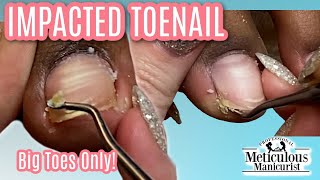 👣Big Toes Only  Impacted Toenail Cuticle Removal w Acrylic Correction amp ASMR👣 [upl. by Zacks]