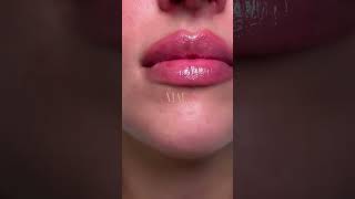 Looking for Best Lip Fillers and Enhancement Advice in Newcastle based Aesthetic Clinics LipGoals [upl. by Drewett]