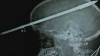 Teenager in Florida survives harpoon through his head [upl. by Selin22]