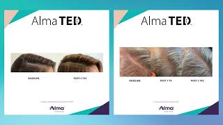 TED TransEpidermal Delivery System for Hair Loss and Hair Shed [upl. by Hoban]