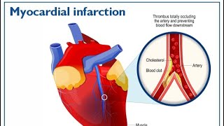 Myocardial infarction STEMIINFERIOR WALL MI amp LATERAL WALL MIECG [upl. by Rhetta]