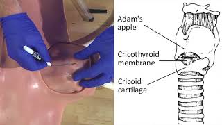 Emergency Needle Cricothyrotomy Procedure Explained [upl. by Notlih]