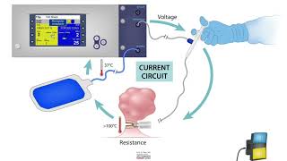 HCC 1472Lesson16bElectrosurgery Monopolar vs Bipolar devices [upl. by Aicilaanna]