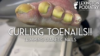 Curling Toenails Trimming Diabetic Nails [upl. by Batty]