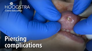 Piercing complications  22193 [upl. by Akeim587]