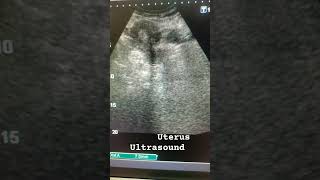 uterus Ultrasound ultrasound ytviral uterus uterusproblem pelvic medical shortsviral shorts [upl. by Leunas]