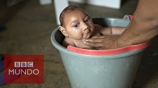 Zika ¿Cómo es la vida del bebé con microcefalia de esta famosa foto [upl. by Khajeh117]